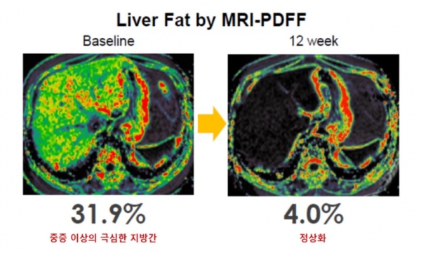 MRI-PDFF 검사로 확인한 지방간 감소 효과. 사진=한미약품 제공.